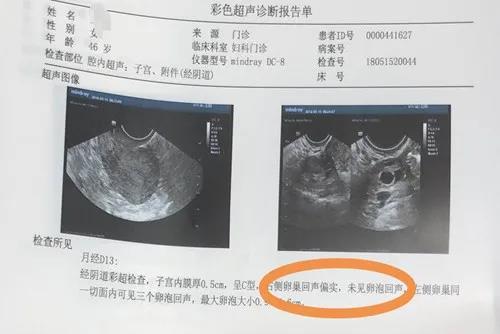 治疗前彩色超声诊断报告单