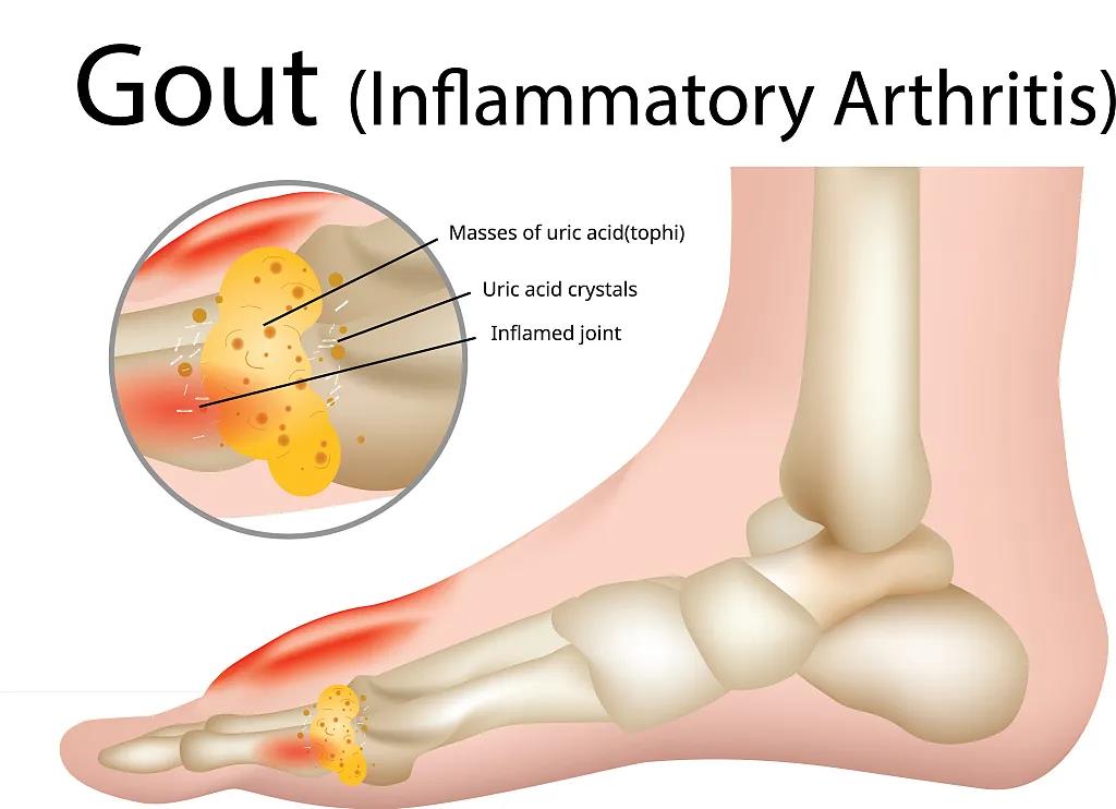 干细胞治疗痛风