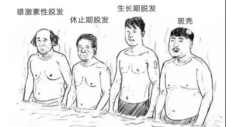 脱发家族四兄弟